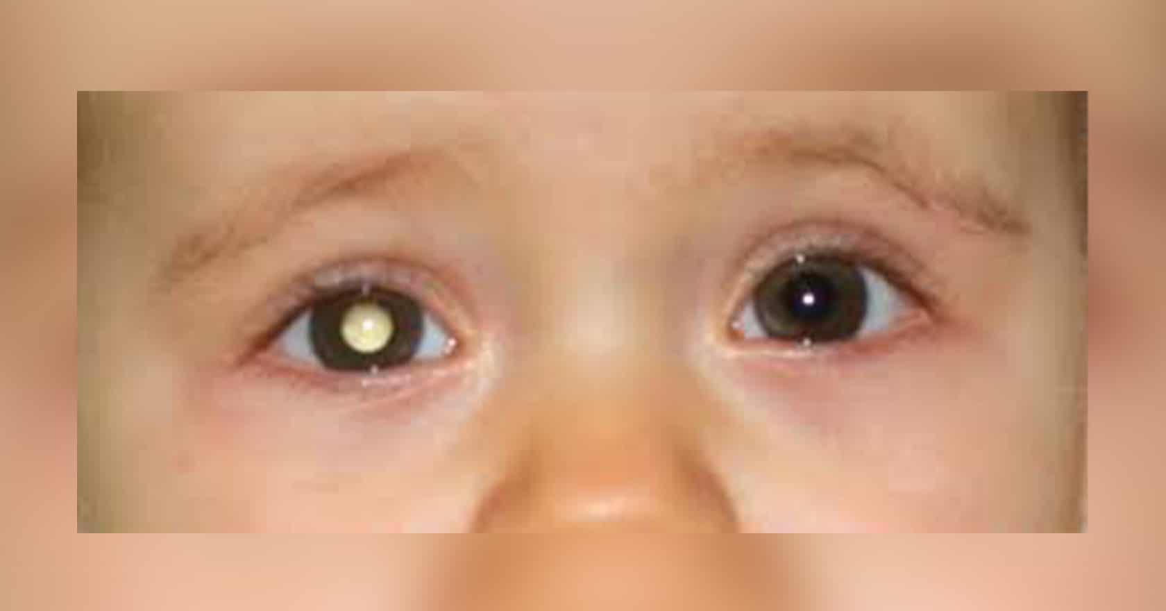Cataracte congénitale : chirurgien ophtalmologue | opération cataracte | Dr Berthon | Lyon