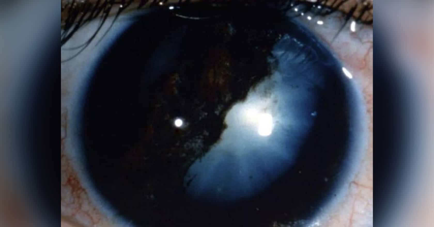 Cataracte induite par les traumatismes | chirurgien ophtalmologue | Dr Laurent Berthon | Lyon