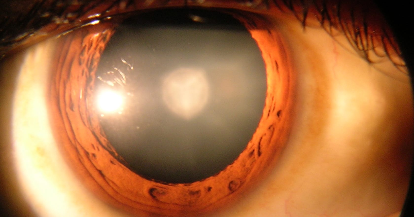 Cataracte nucléaire : chirurgien ophtalmologue | opération cataracte, ophtalmo | Dr Berthon | Lyon