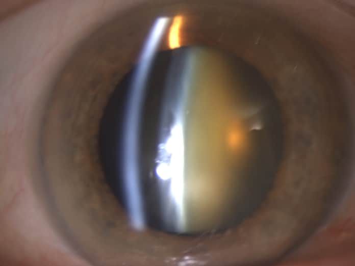 Cataracte nucléaire : chirurgien ophtalmologue | Dr Berthon | Lyon