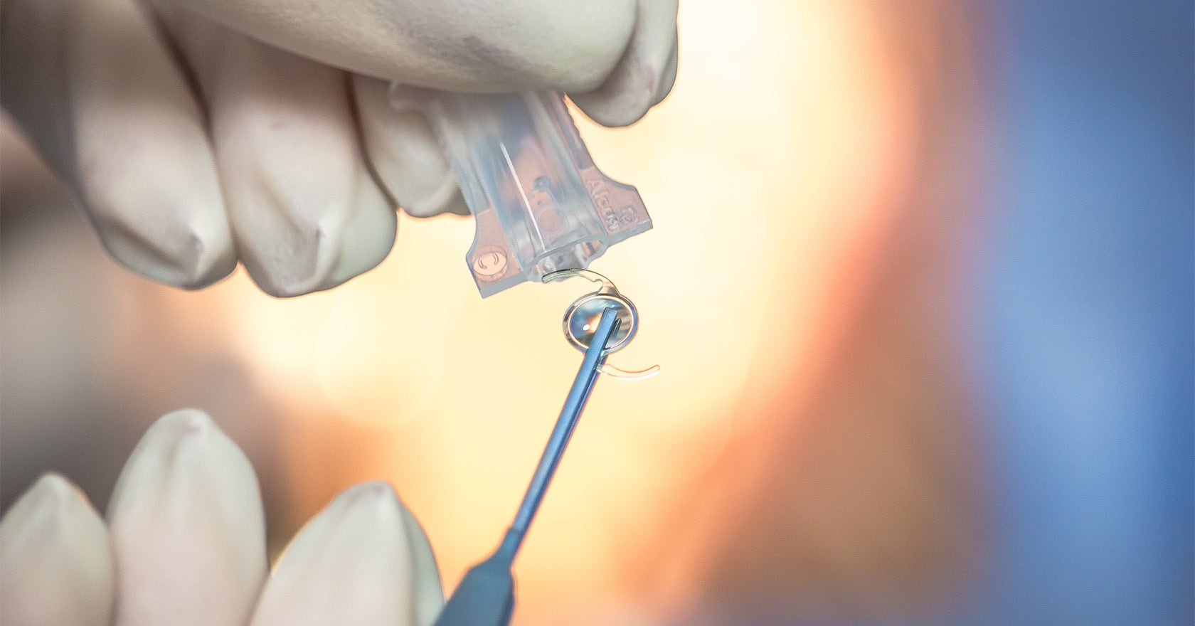 Implants monofocaux : chirurgie cataracte | Chirurgien cataracte | Dr Laurent Berthon | Lyon