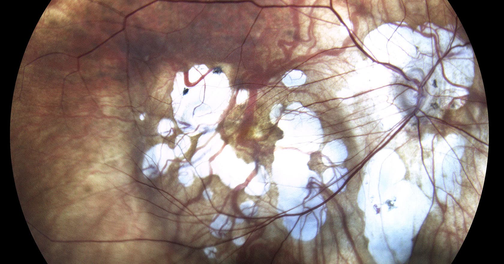 Myopie forte : causes et traitements | Ophtalmologue chirurgien | Dr Laurent Berthon | Lyon