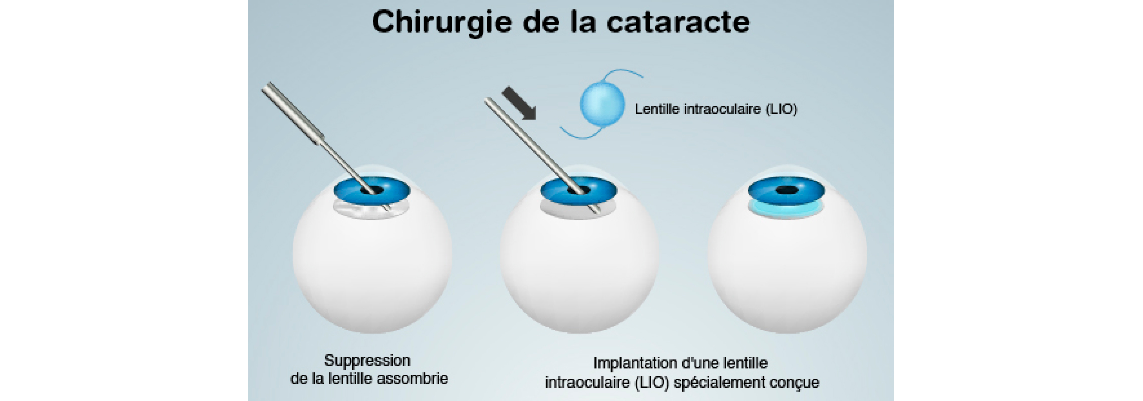 Chirurgie cataracte chirurgien ophtalmologue Opération cataracte à — free download