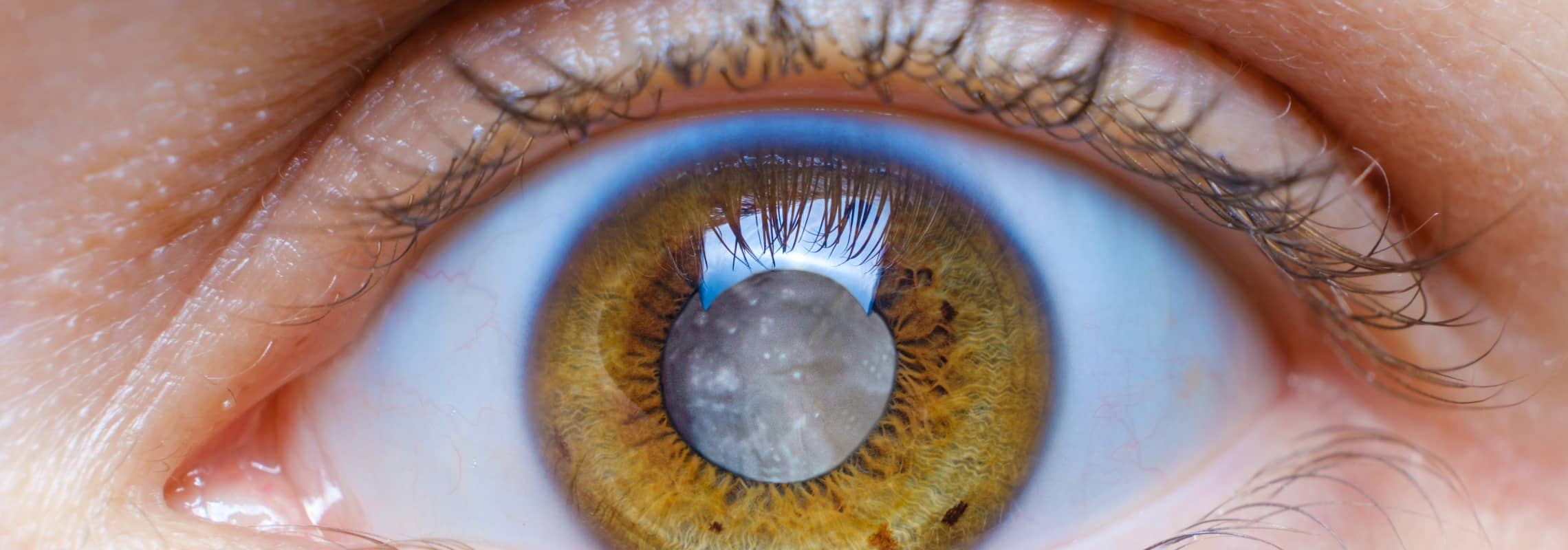 Tout savoir sur le suivi après une chirurgie de la cataracte | Dr Berthon | Lyon