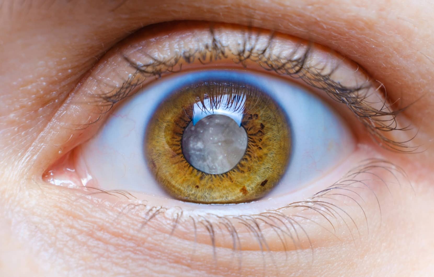 Tout savoir sur le suivi après une chirurgie de la cataracte | Dr Berthon | Lyon