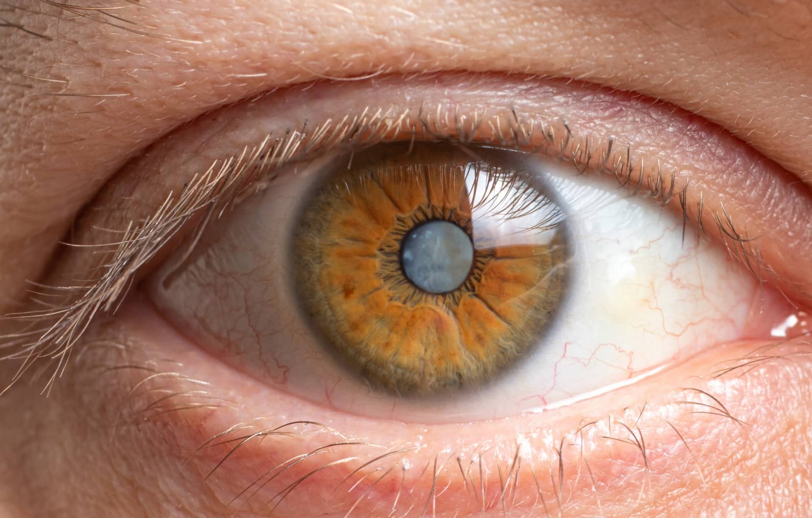 Cataracte : peut-on l’éviter | Dr Berthon | Lyon