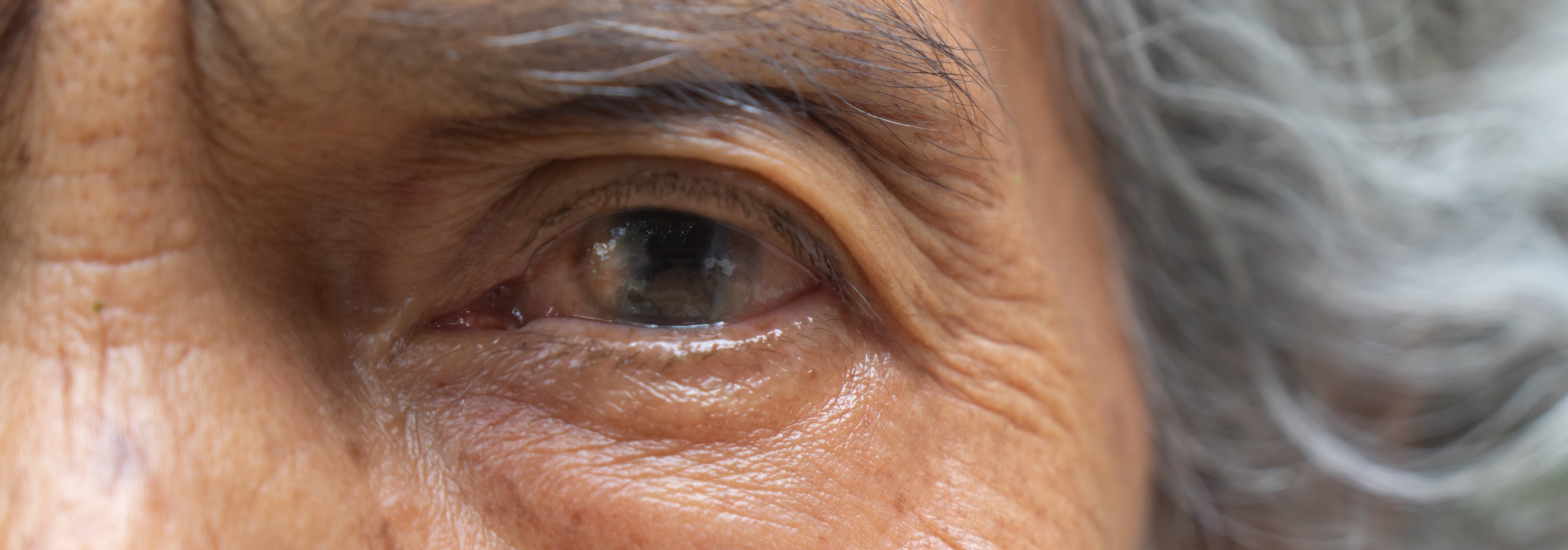 Le Dr Berthon à Lyon vous dit tout sur l’âge limite pour une chirurgie de la cataracte