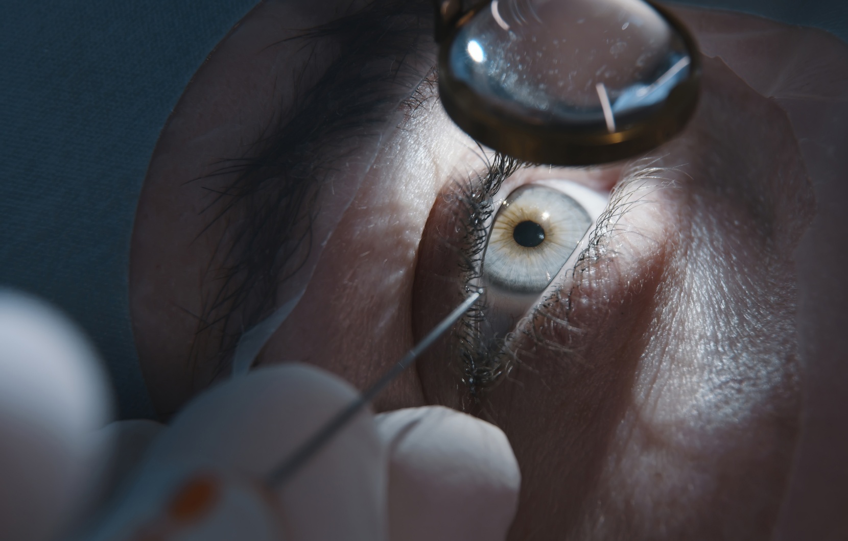 Le Dr Berthon à Lyon vous explique le déroulé et les risques potentiels d’une chirurgie de la cataracte