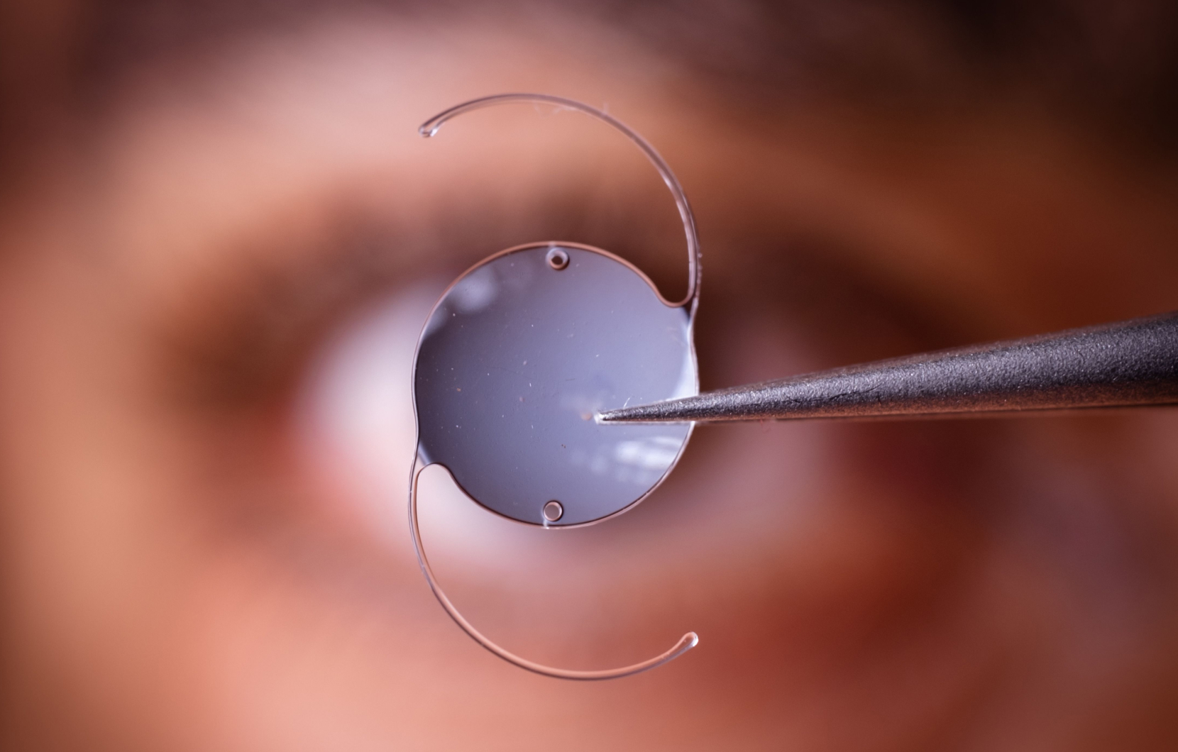 Implants cataracte | Dr Berthon | Lyon